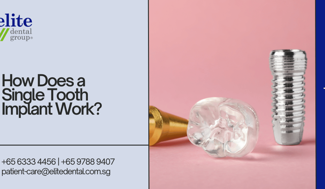 How Does A Single Tooth Implant Work - Elite Dental Group