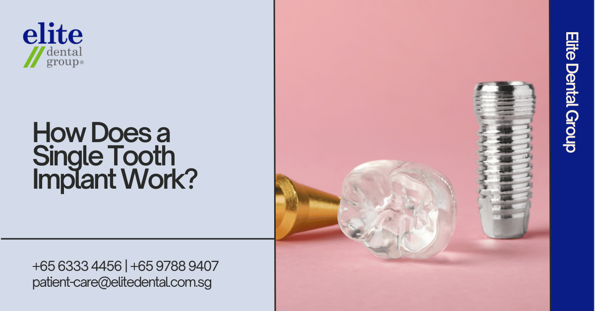 How Does A Single Tooth Implant Work - Elite Dental Group