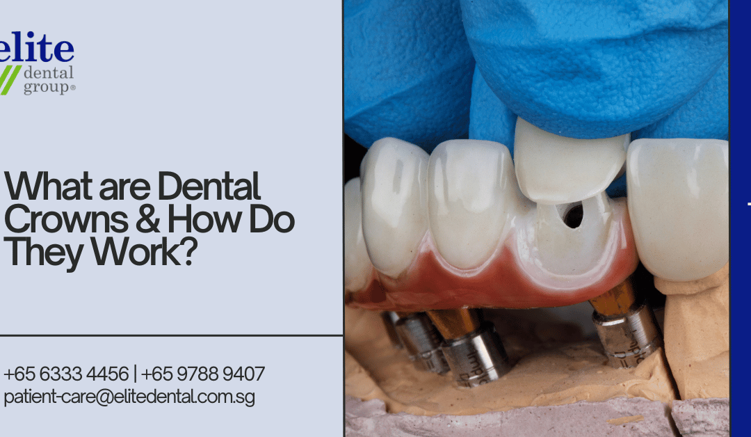 What Are Dental Crowns and How Do They Work? - Elite Dental Group