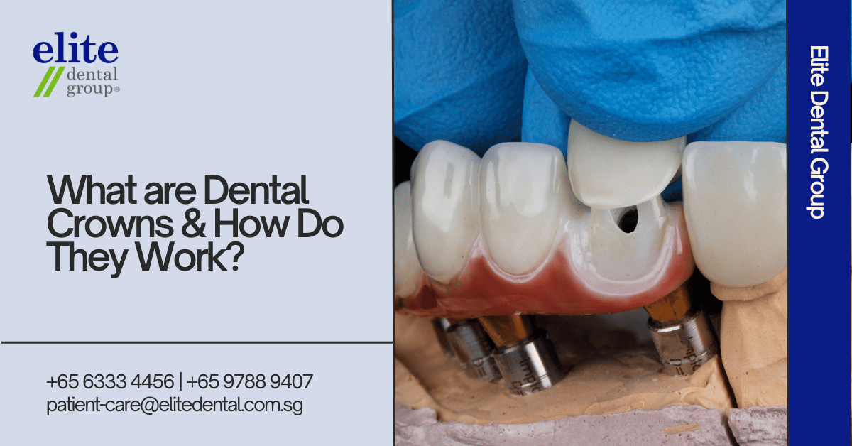 What Are Dental Crowns and How Do They Work? - Elite Dental Group