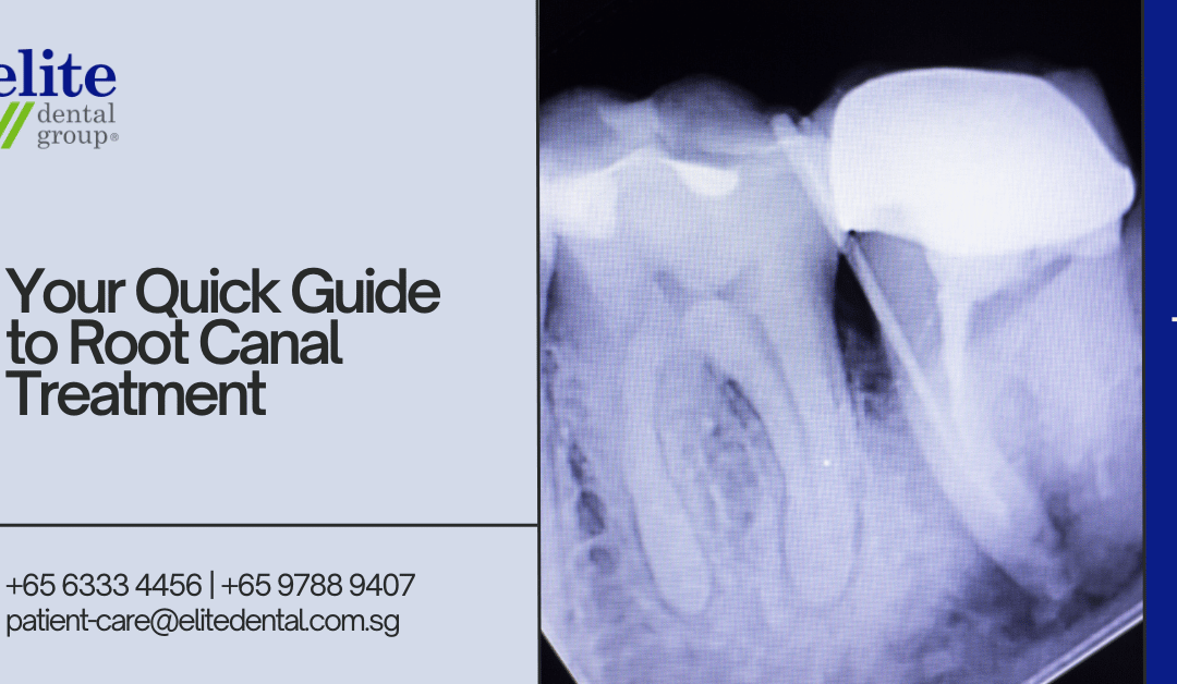 Your Quick Guide to Root Canal Treatment