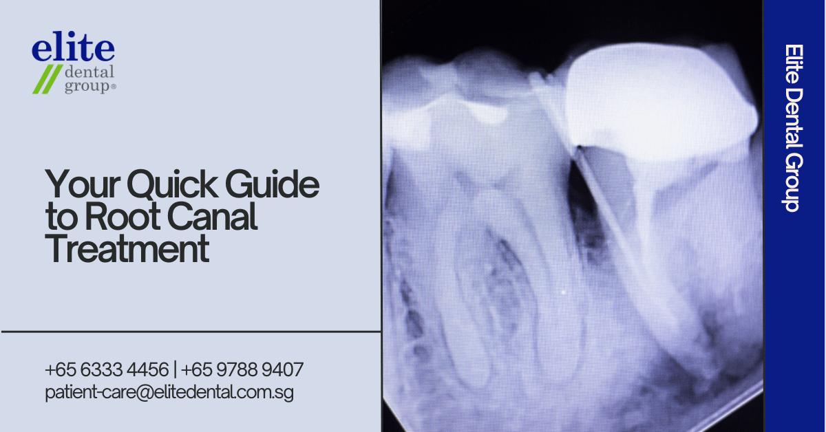 Your Quick Guide To Root Canal Treatment - Elite Dental Group