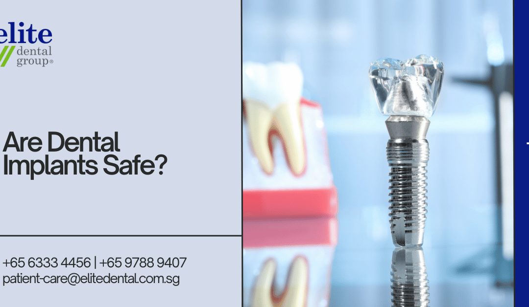 Are Dental Implants Safe - Elite Dental Group