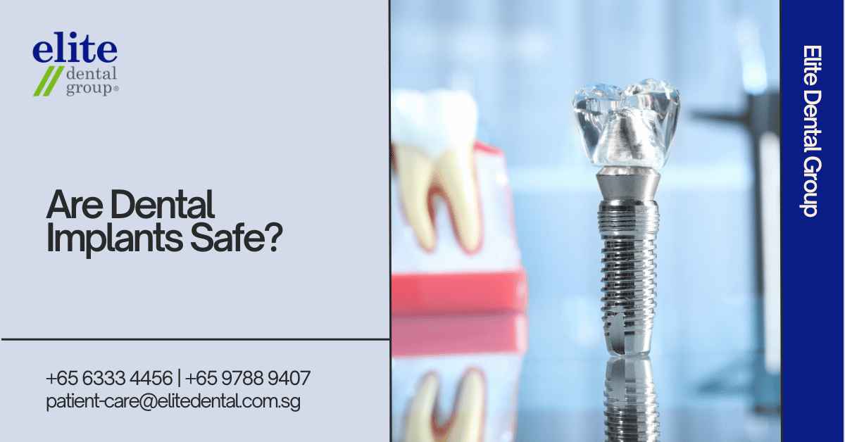 Are Dental Implants Safe - Elite Dental Group