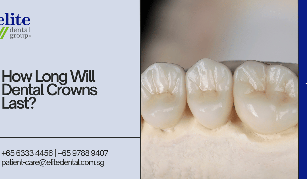 How Long Will Dental Crowns Last - Elite Dental Group