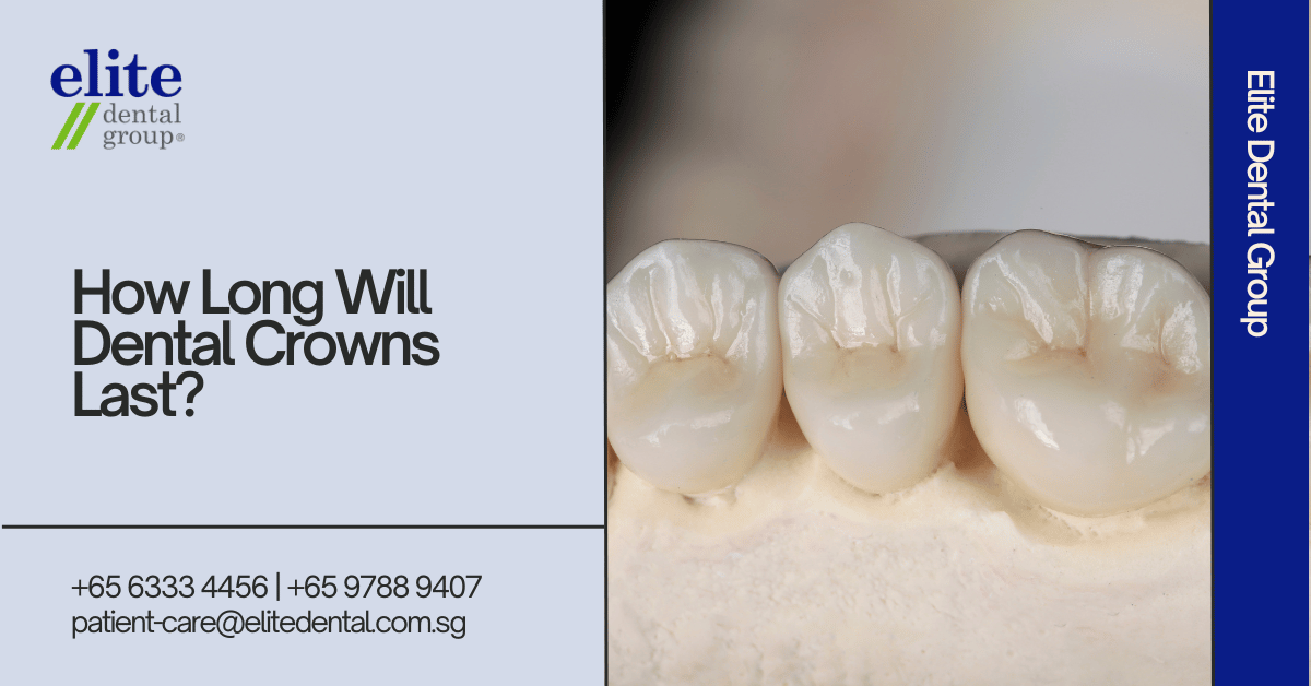 How Long Will Dental Crowns Last - Elite Dental Group