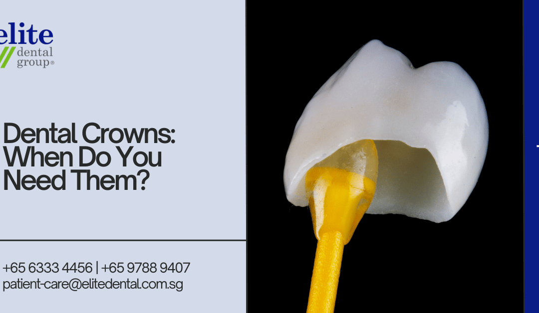 Dental Crowns: When Do You Need Them - Elite Dental Group