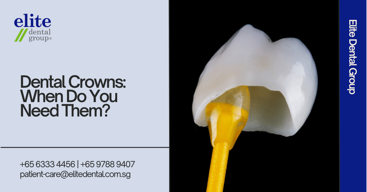 Dental Crowns: When Do You Need Them - Elite Dental Group