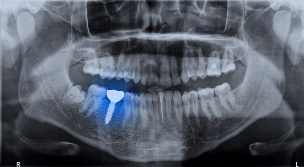 dental implant surgeon in Singapore