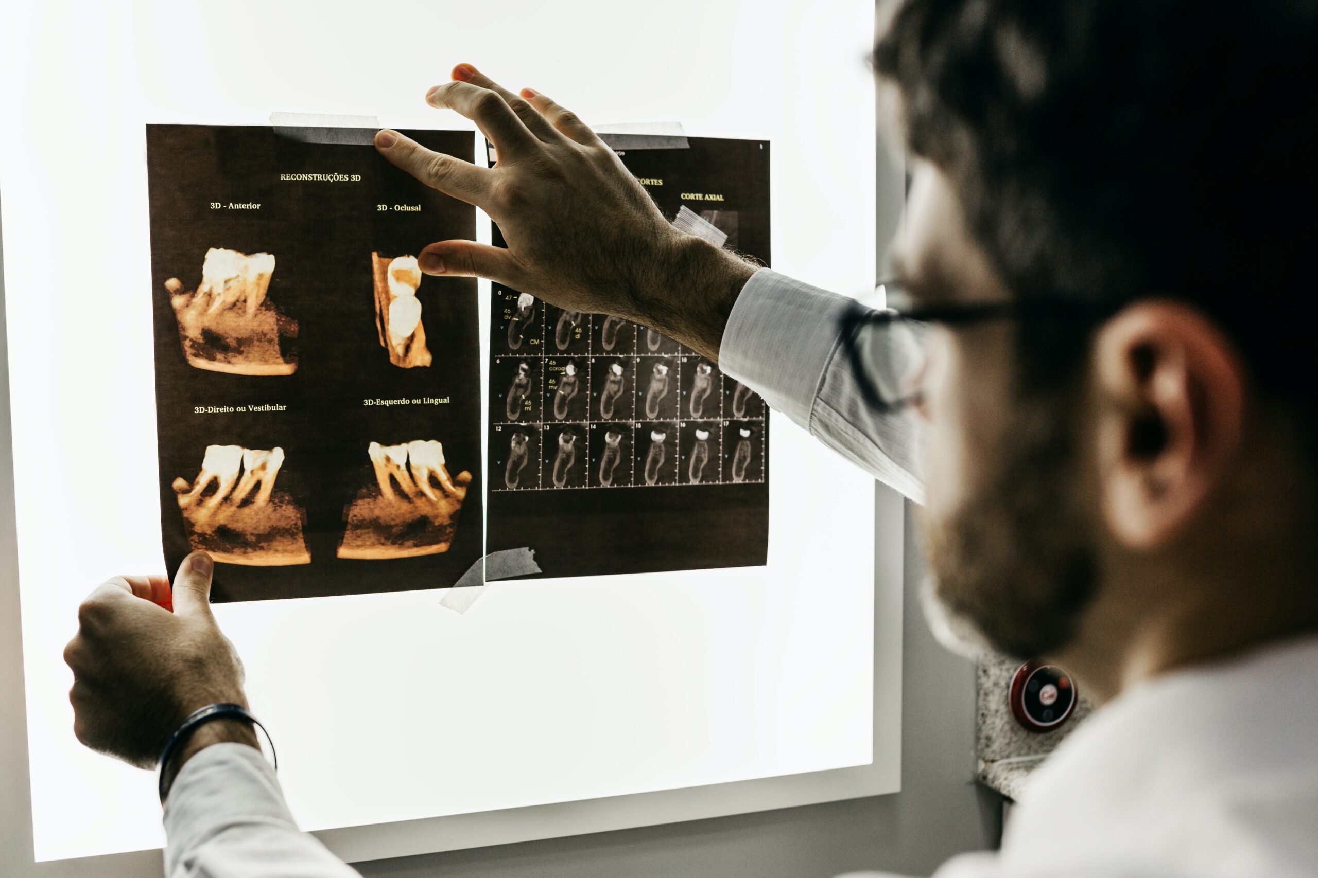 Dentist analysing wisdom tooth placement to determine wisdom tooth surgery cost. 