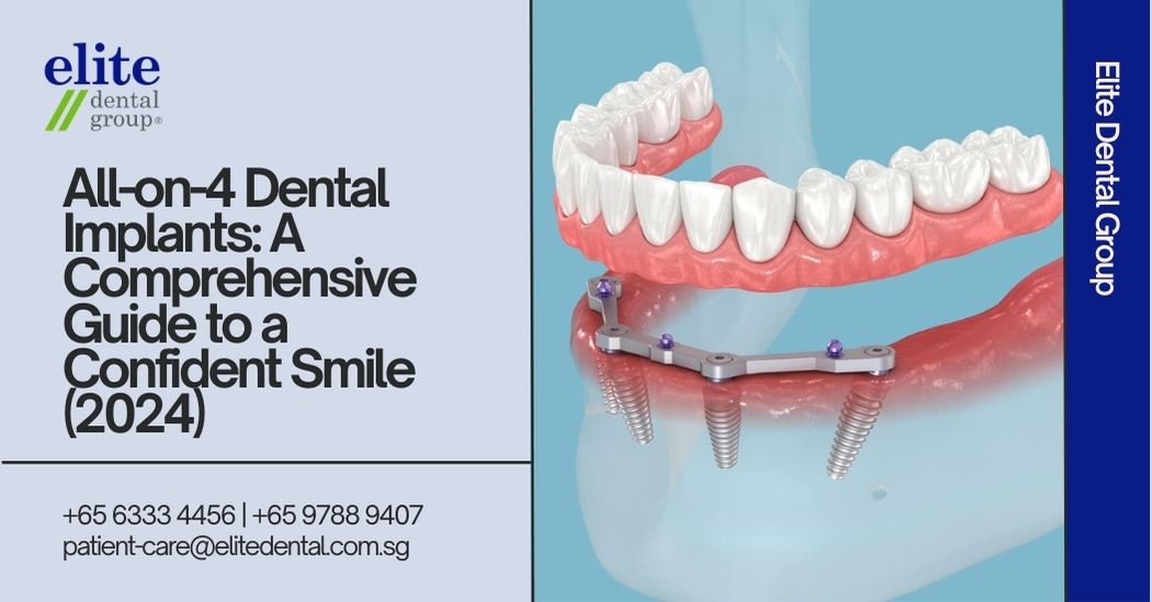 All-on-4 Dental Implants: A Comprehensive Guide to a Confident Smile (2024)