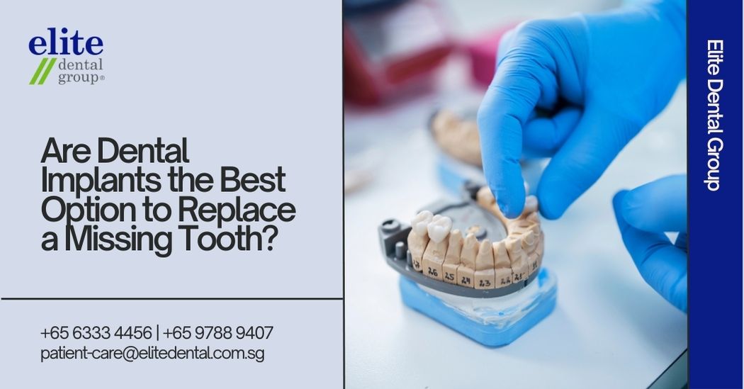 Are Dental Implants the Best Option to Replace a Missing Tooth?