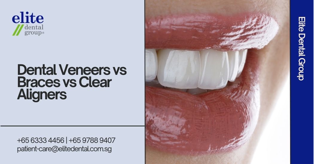 Dental Veneers vs Braces vs Clear Aligners