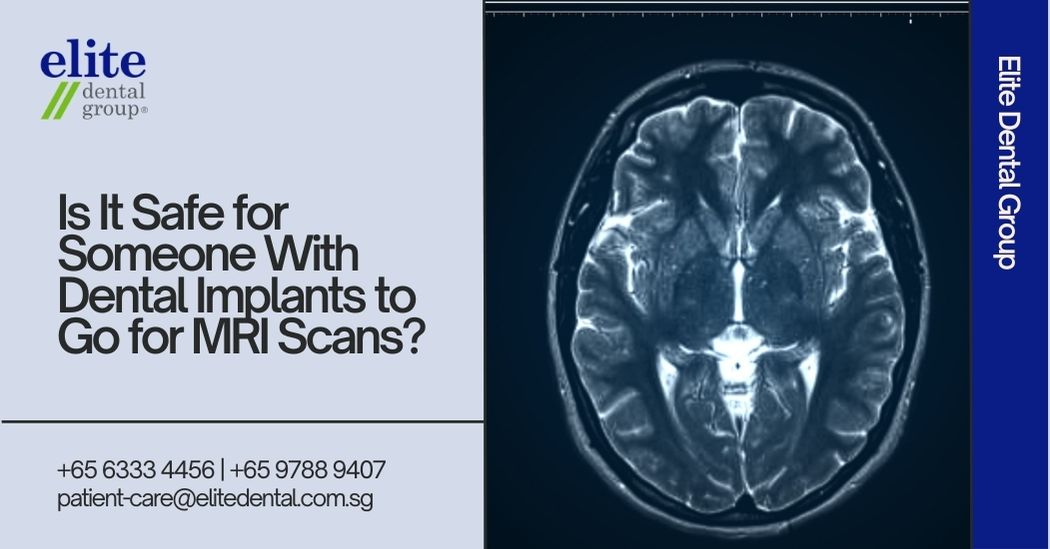 Is It Safe for Someone With Dental Implants to Go for MRI Scans?