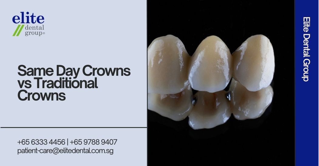 Same Day Crowns vs Traditional Crowns