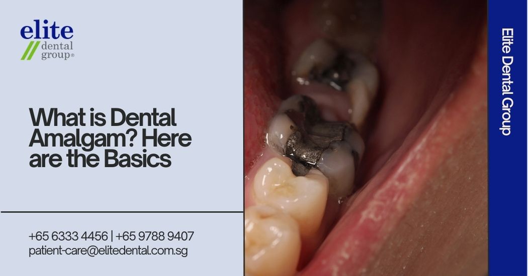 What is Dental Amalgam? Here are the Basics