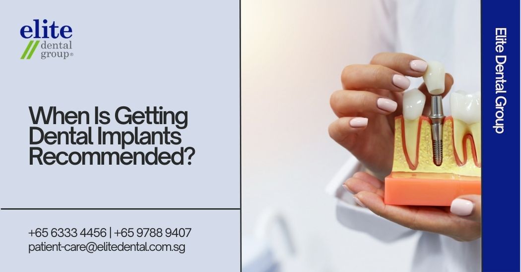 When Is Getting Dental Implants Recommended?